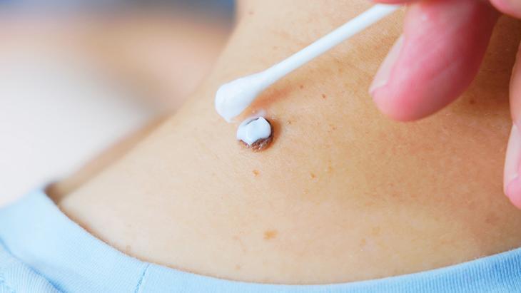 lazer de yaptiran da var solusyon suren de her ben masum degil incelenmeli NnxxAafT.jpg